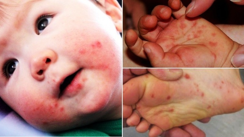  Volta às aulas: pais e responsáveis devem ficar alertas à Síndrome mão-pé-boca