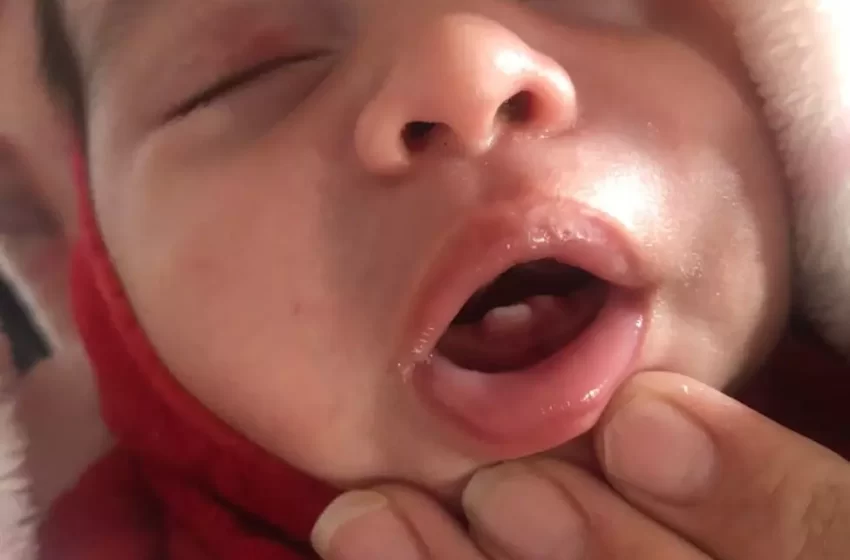  Bebê nasceu com três dentes e virou fenômeno em hospital de SC